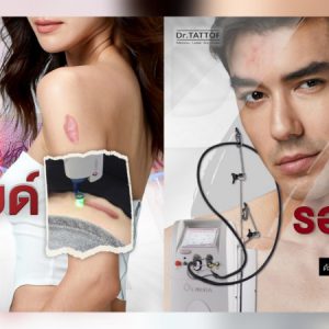 Dr.TATTOF ยกระดับการรักษาผิวด้วยเลเซอร์โปรแกรม VBeam เลเซอร์รักษารอยแดง สิวอักเสบ ปานแดง และคีลอยด์อย่างมีประสิทธิภาพ