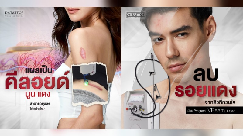 Dr.TATTOF ยกระดับการรักษาผิวด้วยเลเซอร์โปรแกรม VBeam เลเซอร์รักษารอยแดง สิวอักเสบ ปานแดง และคีลอยด์อย่างมีประสิทธิภาพ